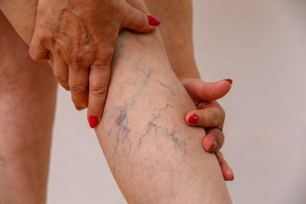 Varicose veins surgery